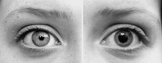 Dilated-Vs-Contracted-Pupils.jpg